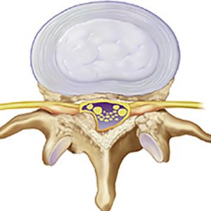 Spinal stenosis – Dr HOA PAIN & PHYSIOTHERAPY CLINIC